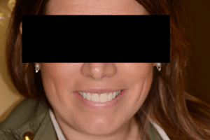 Woman with a great smile After Porcelain Veneers