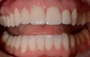 Great Smile After Porcelain Veneers