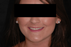 Before Porcelain Veneers