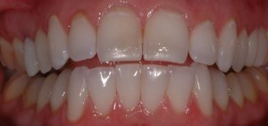 After Porcelain Veneers