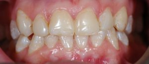 Before Porcelain Veneers