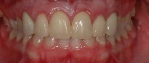 After Anterior Crowns