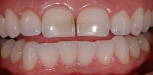 Before Anterior Crowns
