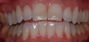 After Anterior Crowns