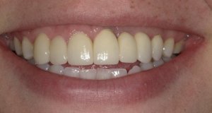 After Anterior Dental Implants