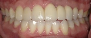 After Anterior Dental Implants