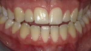 After Anterior Dental Implants