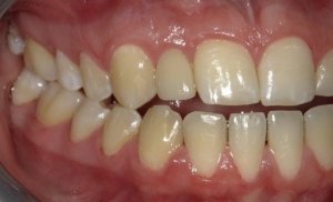 After Anterior Dental Implants