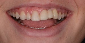 Before Anterior Dental Implants