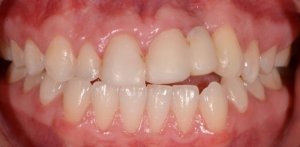 Before Anterior Dental Implants