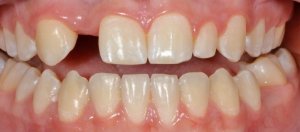Before Anterior Dental Implants
