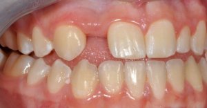 Before Anterior Dental Implants