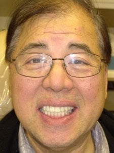 A man with a nice smile after Hybridge Dental Implants