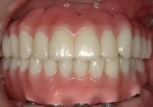 A beautiful smile After Hybridge Dental Implants