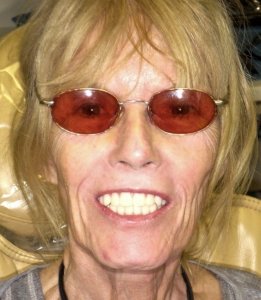 Woman with a great smile After Hybridge Dental Implants