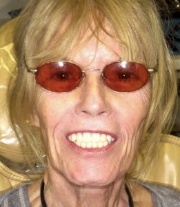Woman with a great smile After Hybridge Dental Implants
