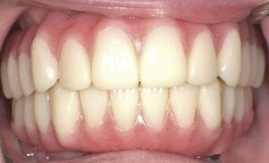 Great smile After Hybridge Dental Implants