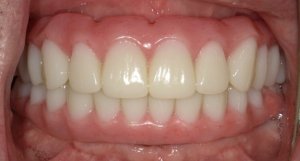 Beautiful smile After Hybridge Dental Implants