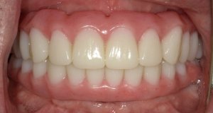 Beautiful smile After Hybridge Dental Implants