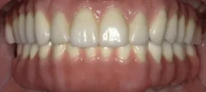 Restored smile After Hybridge Dental Implants