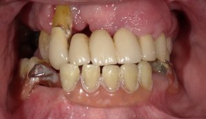 Before Hybridge Dental Implants