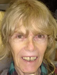 A woman with a gap in her teeth Before Hybridge Dental Implants