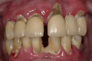 A smile with a gap Before Hybridge Dental Implants