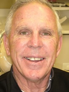 Man with an uneven smile Before Hybridge Dental Implants