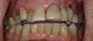 Crooked and uneven teeth Before Hybridge Dental Implants