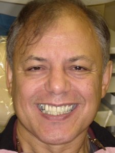 Man with a crooked smile Before Hybridge Dental Implants