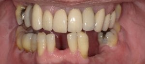 Incomplete smile Before Hybridge Dental Implants