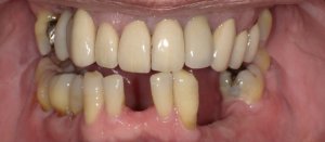 Incomplete smile Before Hybridge Dental Implants